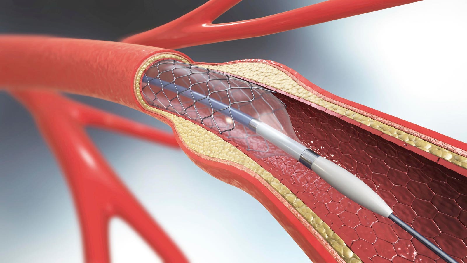 Taxpayers Spent Over 0 Million For Unnecessary Coronary Stents A Year, Report Finds