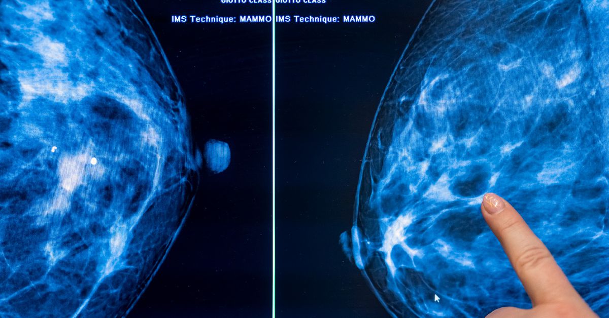 Why more mammograms aren’t the solution to breast cancer